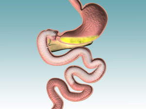 EndoBarrier for weight loss