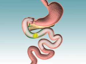 EndoBarrier for weight loss
