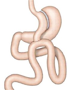Mini Gastric Bypass for Weight Loss Surgery or Bariatric Surgery