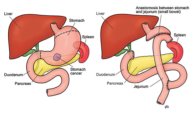 cancer gastric bypass
