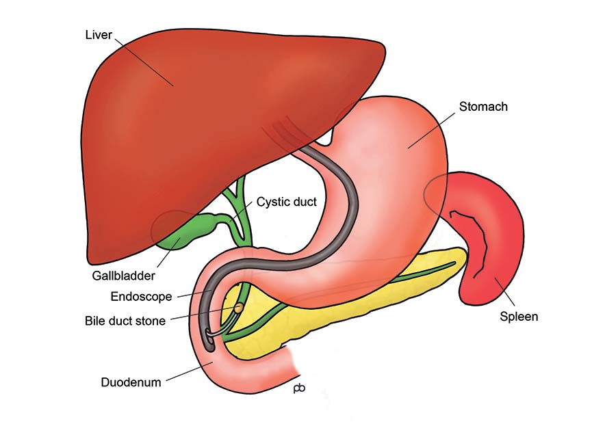 Gallstone Ileus After Cholecystectomy Diet After Surgery