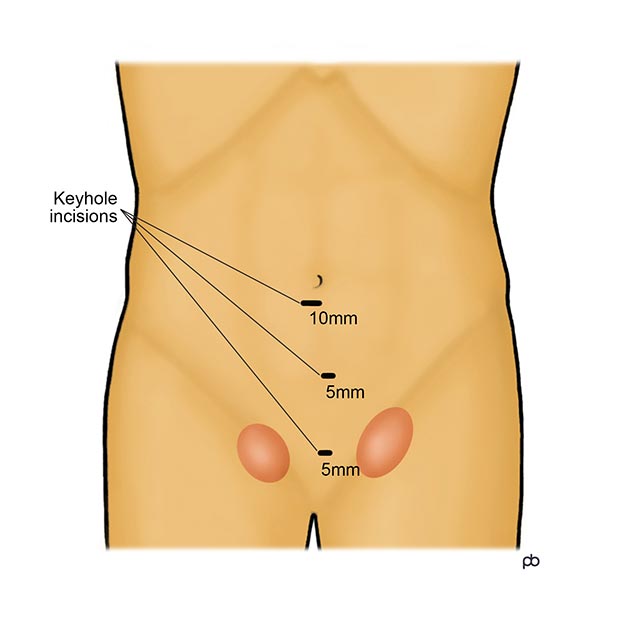 Abeezar Sarela, Keyhole Surgery, Inguinal Hernia