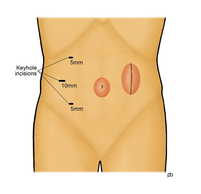 Abeezar Sarela, Umbilical Hernia