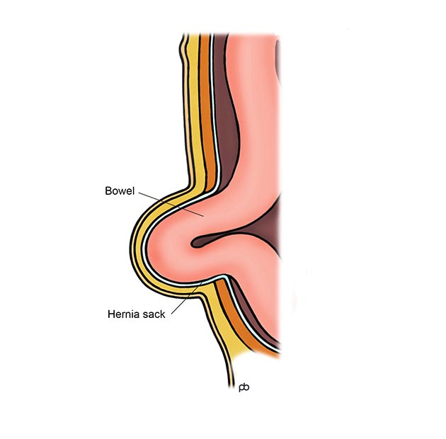 Femoral Hernia Cause Weight Loss