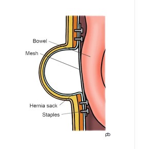 Abeezar Sarela| Umbilical Hernia| Para-Umbilical Hernia