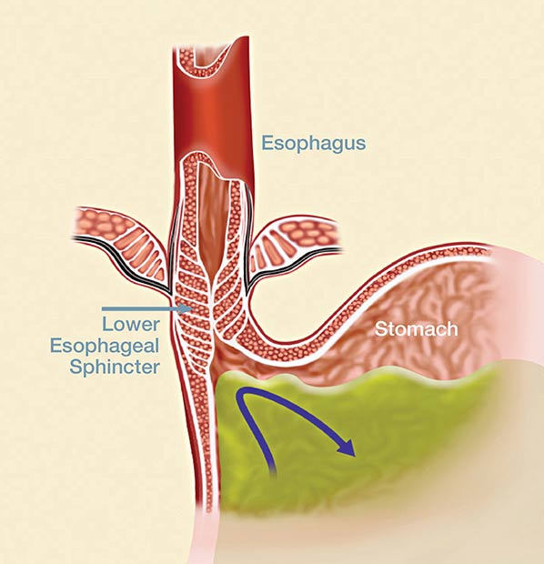 What is a Hiatal Hernia? - Houston Heartburn and Reflux Center