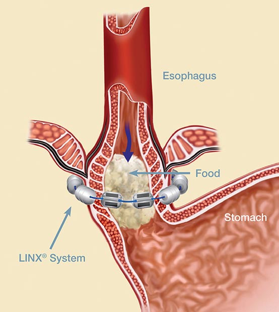 Acupuncture Alleviates GERD And Heartburn